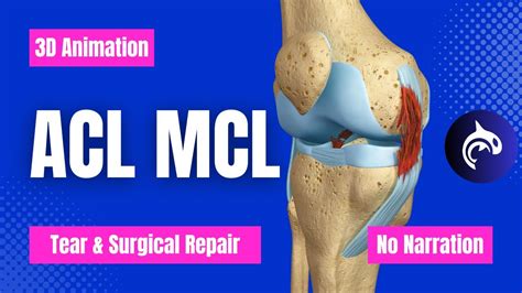 acl mcl tear test|mcl acl tear recovery time.